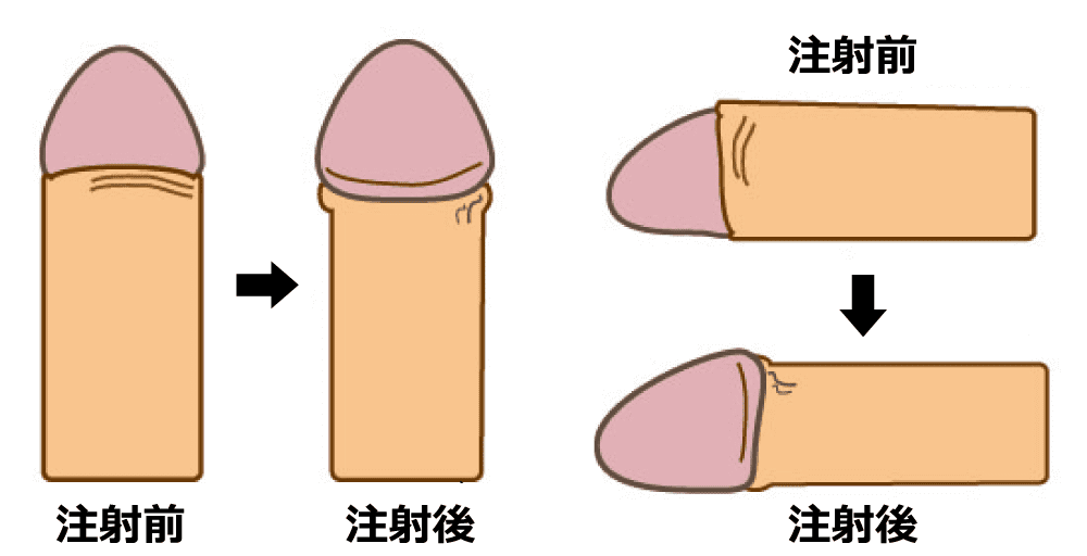 注射の前後比較